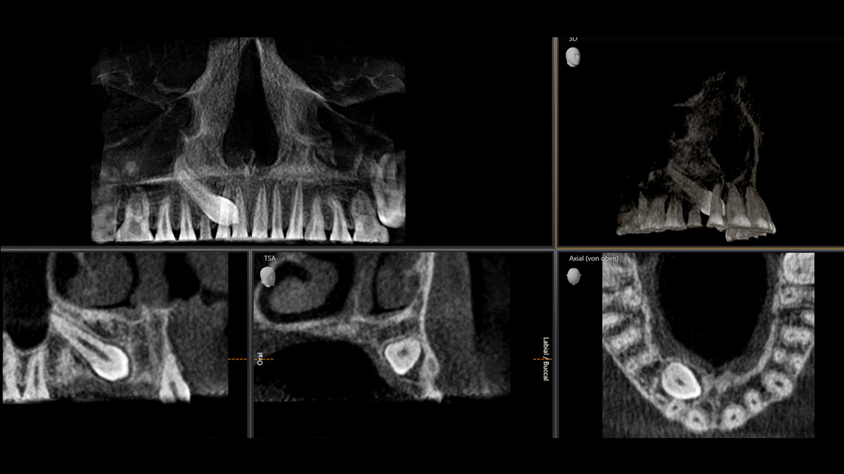 Dental X-Ray
